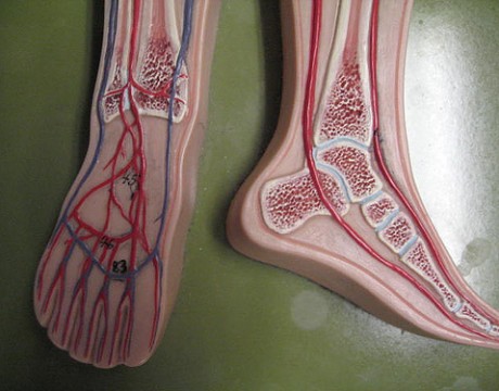 peripheral artery disease