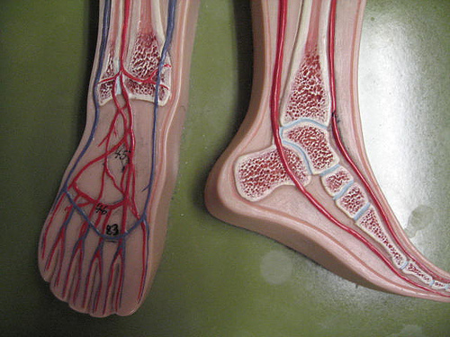 peripheral artery disease