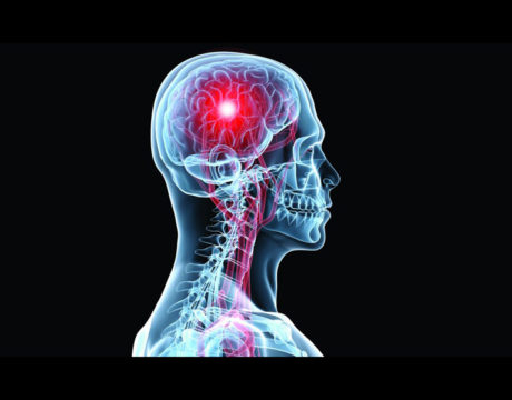 Stroke Survivors