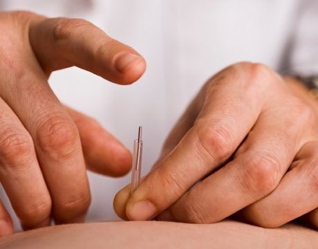 Acupuncture